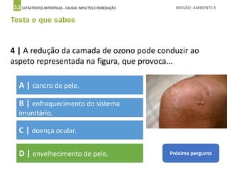 3.2 CATÁSTROFES ANTRÓPICAS – CAUSAS, IMPACTES E REMEDIAÇÃO MISSÃO: AMBIENTE 8
Testa o que sabes
4 | A redução da camada de ozono pode conduzir ao
aspeto representada na figura, que provoca...
A | cancro de pele.
B | enfraquecimento do sistema
imunitário.
C | doença ocular.
D | envelhecimento de pele. Próxima pergunta
 