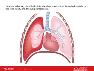In a hemothorax, blood leaks into the chest cavity from lacerated vessels or
the lung itself, and the lung compresses.
 