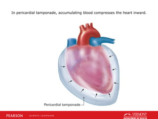 In pericardial tamponade, accumulating blood compresses the heart inward.
 