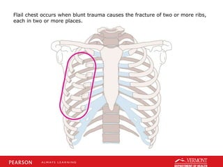 Flail chest occurs when blunt trauma causes the fracture of two or more ribs,
each in two or more places.
 
