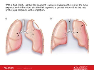 With a flail chest, (a) the flail segment is drawn inward as the rest of the lung
expands with inhalation; (b) the flail segment is pushed outward as the rest
of the lung contracts with exhalation.
 