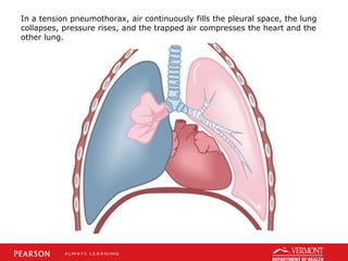 In a tension pneumothorax, air continuously fills the pleural space, the lung
collapses, pressure rises, and the trapped air compresses the heart and the
other lung.
 