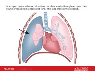 In an open pneumothorax, air enters the chest cavity through an open chest
wound or leaks from a lacerated lung. The lung then cannot expand.
 