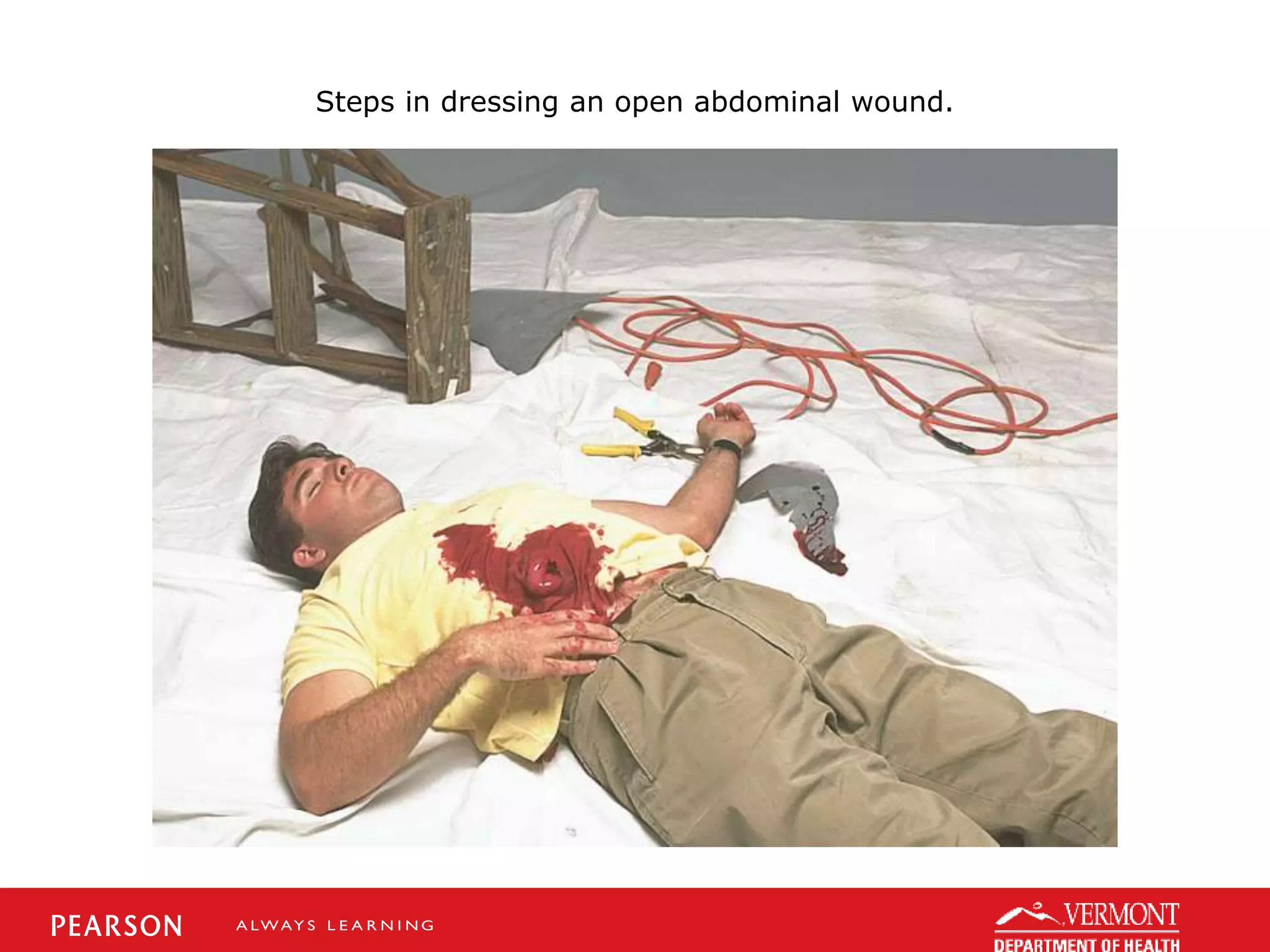 Steps in dressing an open abdominal wound.
 