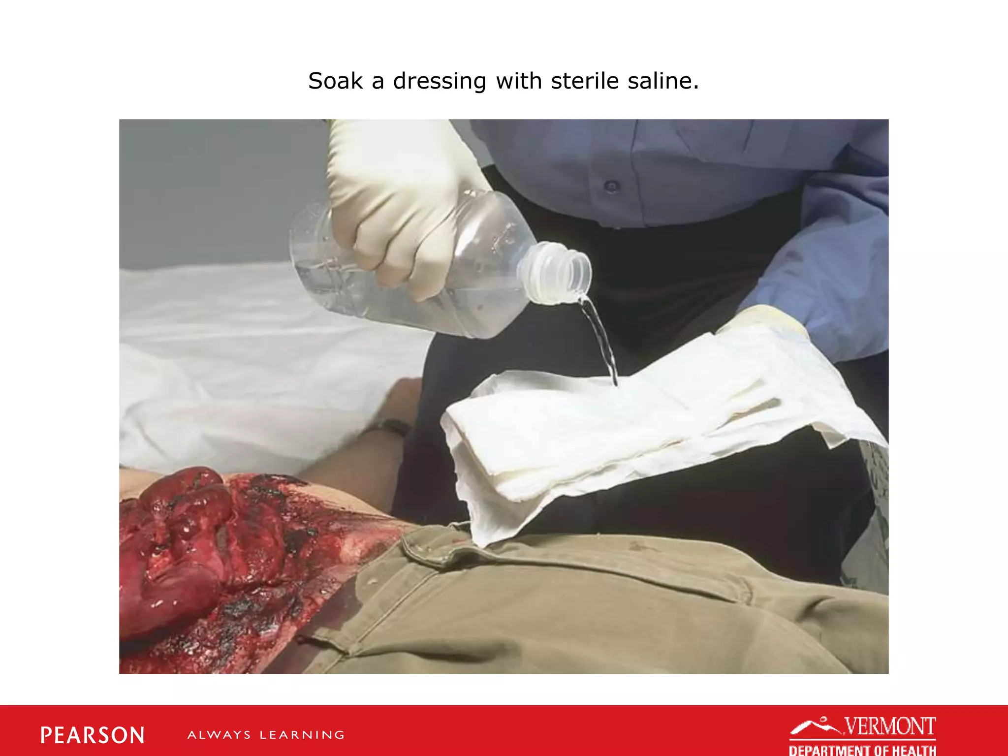 Soak a dressing with sterile saline.
 