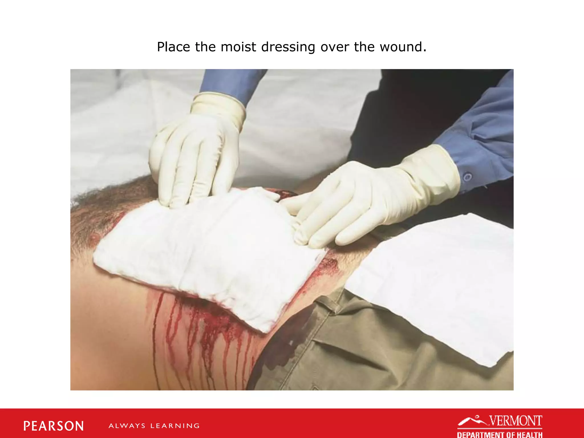 Place the moist dressing over the wound.
 