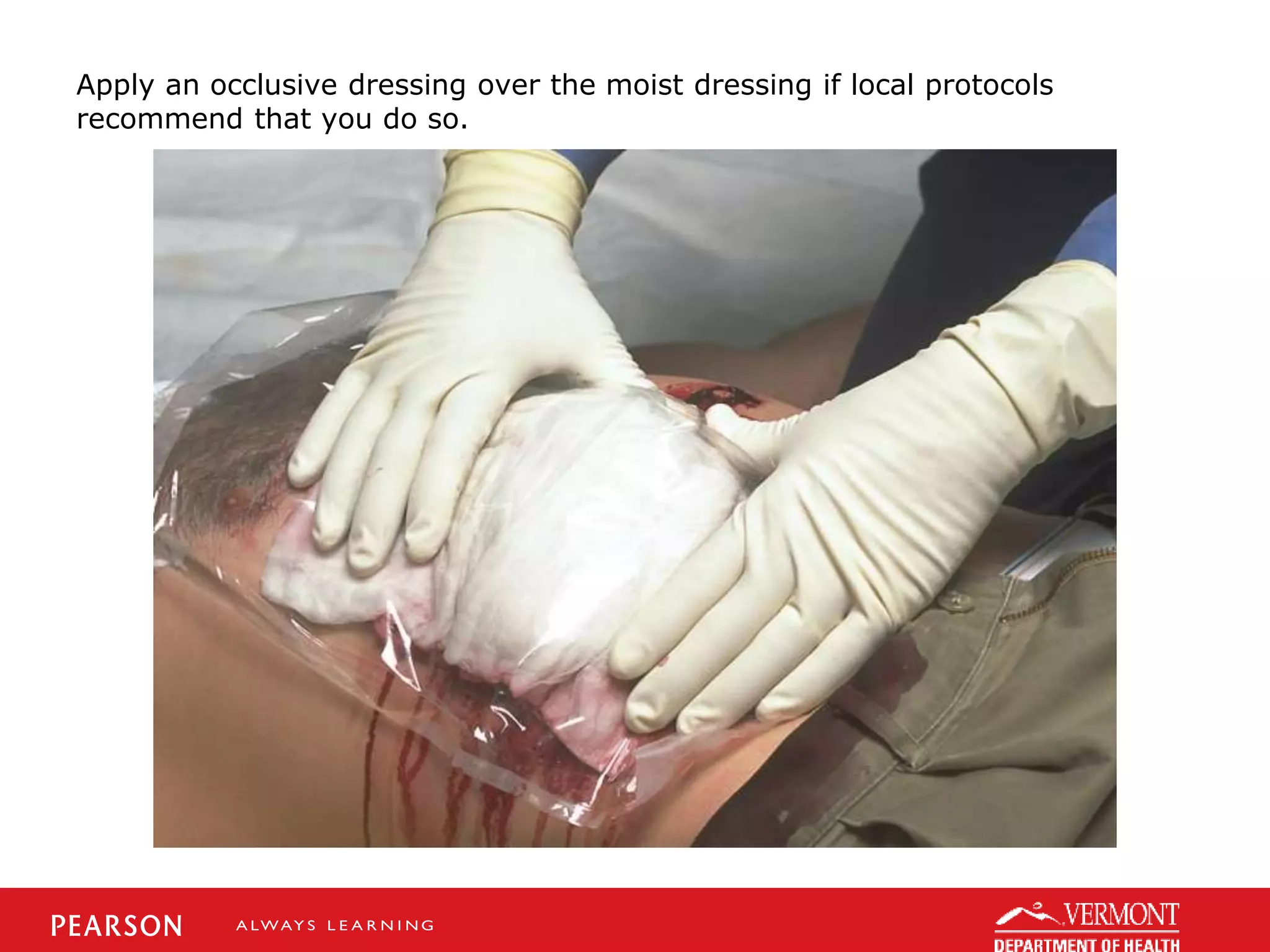 Apply an occlusive dressing over the moist dressing if local protocols
recommend that you do so.
 