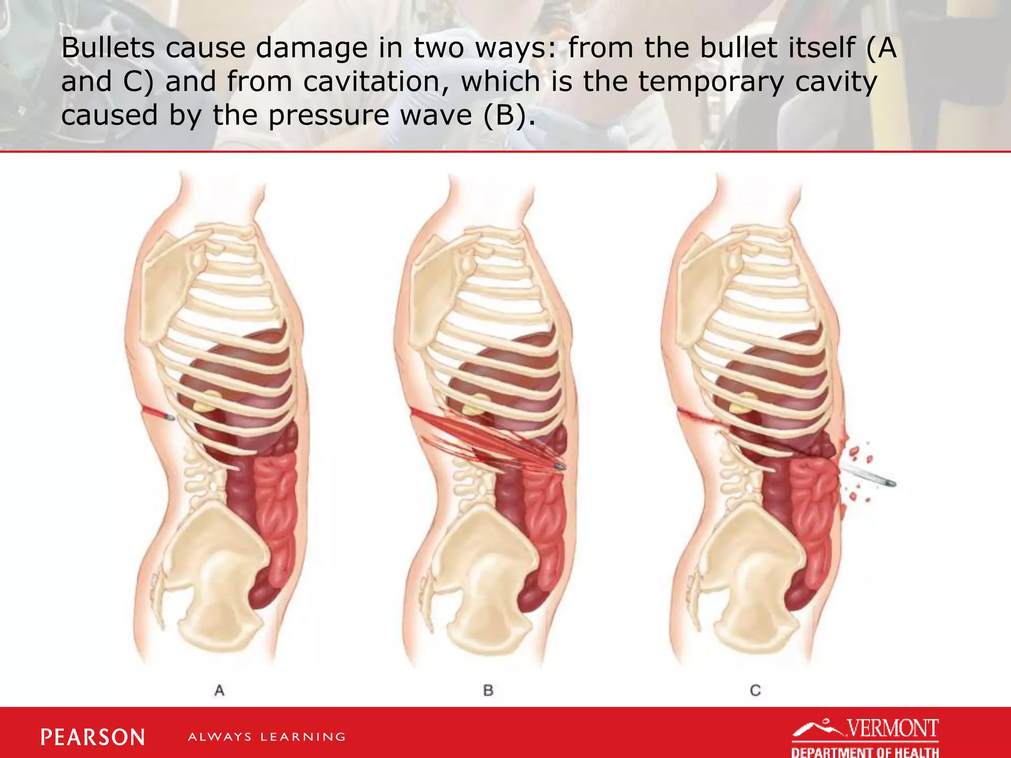 Bullets cause damage in two ways: from the bullet itself (A
and C) and from cavitation, which is the temporary cavity
caused by the pressure wave (B).
 