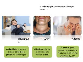 Obesidad
e
Bócio
A obesidade resulta do
excesso de lípidos e
glícidos na alimentação.
O bócio resulta da
carência de um
mineral, o iodo.
A anemia pode
resultar da carência de
ferro, mas também das
vitaminas B12 e D.
A malnutrição pode causar doenças
como...
Anemia
 