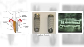 Implante Dentário.
 