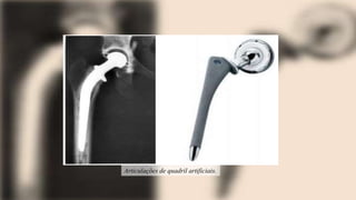 Articulações de quadril artificiais.
 
