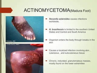ACTINOMYCETOMA(Madura Foot)
 Nocardia asteroides causes infections
worldwide,
 N. brasiliensis is limited to the southern United
States and Central and South America
 Organism enters the body through breaks in the
skin
 Causes a localized infection involving skin ,
cutaneous , and subcutaneous tissue
 Chronic, indurated, granulomatous masses,
mostly found on the lower extremities
 
