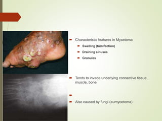  Characteristic features in Mycetoma
 Swelling (tumifaction)
 Draining sinuses
 Granules
 Tends to invade underlying connective tissue,
muscle, bone

 Also caused by fungi (eumycetoma)
 