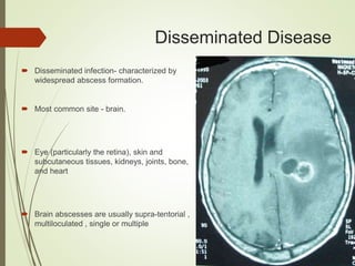Disseminated Disease
 Disseminated infection- characterized by
widespread abscess formation.
 Most common site - brain.
 Eye (particularly the retina), skin and
subcutaneous tissues, kidneys, joints, bone,
and heart
 Brain abscesses are usually supra-tentorial ,
multiloculated , single or multiple
 