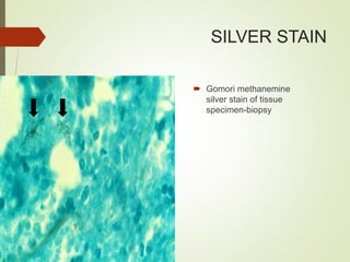 SILVER STAIN
 Gomori methanemine
silver stain of tissue
specimen-biopsy
 