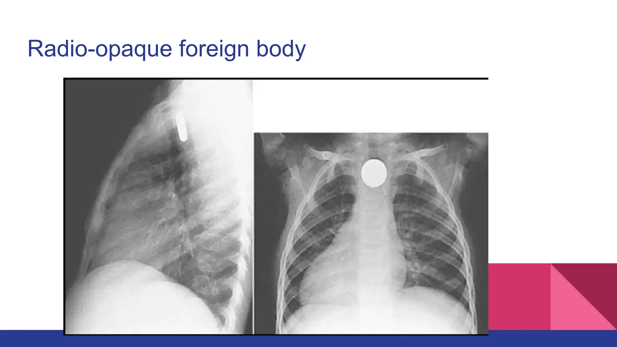 Aerodigestive Foreign Bodies Of the Nose and Throat.pptx