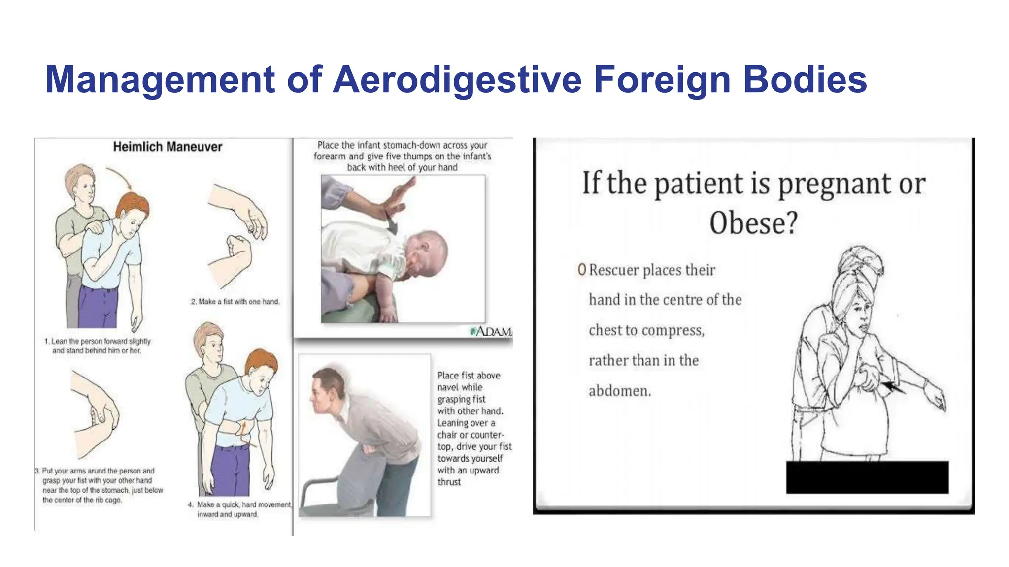 Aerodigestive Foreign Bodies Of the Nose and Throat.pptx