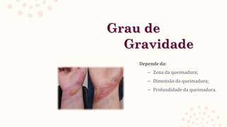 Grau de
Gravidade
Depende da:
– Zona da queimadura;
– Dimensão da queimadura;
– Profundidade da queimadura.
 