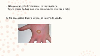 – Não colocar gelo diretamente na queimadura;
– Se existirem bolhas, não se rebentam nem se retira a pele;
Se for necessário levar a vítima ao Centro de Saúde.
 