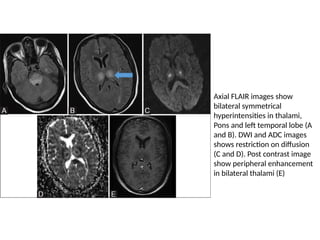 AES acute encephalitis syndrome ppt 1.pptx