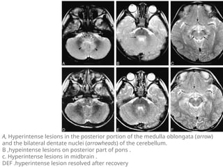 AES acute encephalitis syndrome ppt 1.pptx