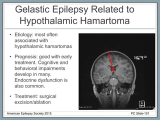 Gelastic Epilepsy Related to
Hypothalamic Hamartoma
• Etiology: most often
associated with
hypothalamic hamartomas
• Prognosis: good with early
treatment. Cognitive and
behavioral impairments
develop in many.
Endocrine dysfunction is
also common.
• Treatment: surgical
excision/ablation
American Epilepsy Society 2015 PC Slide-101
 