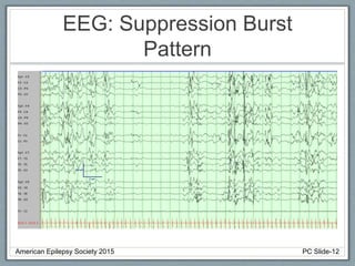 EEG: Suppression Burst
Pattern
American Epilepsy Society 2015 PC Slide-12
 