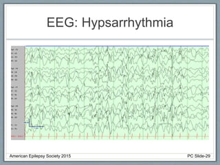EEG: Hypsarrhythmia
American Epilepsy Society 2015 PC Slide-29
 