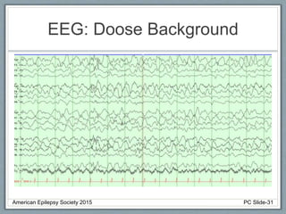 EEG: Doose Background
American Epilepsy Society 2015 PC Slide-31
 