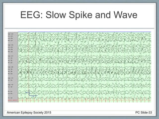 EEG: Slow Spike and Wave
American Epilepsy Society 2015 PC Slide-33
 