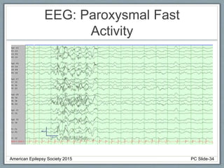 EEG: Paroxysmal Fast
Activity
American Epilepsy Society 2015 PC Slide-34
 