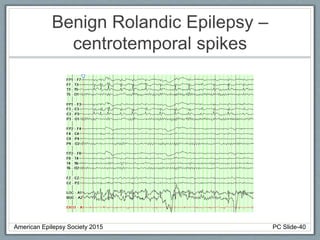Benign Rolandic Epilepsy –
centrotemporal spikes
American Epilepsy Society 2015 PC Slide-40
 