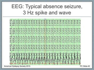 EEG: Typical absence seizure,
3 Hz spike and wave
American Epilepsy Society 2015 PC Slide-45
 