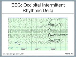 EEG: Occipital Intermittent
Rhythmic Delta
American Epilepsy Society 2015 PC Slide-46
 