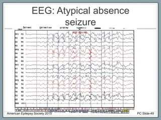 EEG: Atypical absence
seizure
American Epilepsy Society 2015 PC Slide-49
 
