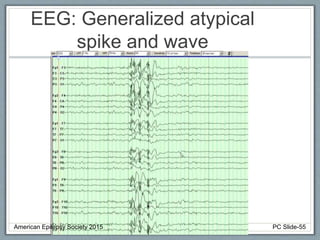 EEG: Generalized atypical
spike and wave
American Epilepsy Society 2015 PC Slide-55
 