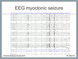 EEG myoclonic seizure
American Epilepsy Society 2015 PC Slide-56
 
