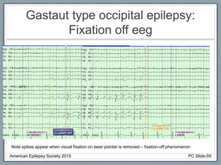 Gastaut type occipital epilepsy:
Fixation off eeg
Note spikes appear when visual fixation on laser pointer is removed – fixation-off phenomenon
American Epilepsy Society 2015 PC Slide-59
 