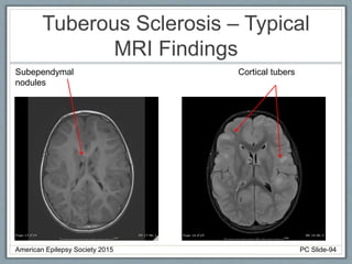 Tuberous Sclerosis – Typical
MRI Findings
Subependymal
nodules
Cortical tubers
American Epilepsy Society 2015 PC Slide-94
 