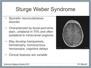 Sturge Weber Syndrome
• Sporadic neurocutaneous
disorder
• Characterized by facial port-wine
stain, unilateral in 70% and often
ipsilateral to intracranial angioma
• May develop hemiparesis,
hemiatrophy, homonymous
hemianopia, cognitive delays
• Clinical features are variable
American Epilepsy Society 2015 PC Slide-95
 