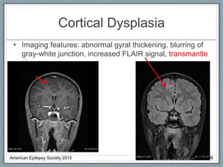 Cortical Dysplasia
• Imaging features: abnormal gyral thickening, blurring of
gray-white junction, increased FLAIR signal, transmantle
sign
American Epilepsy Society 2015 PC Slide-99
 