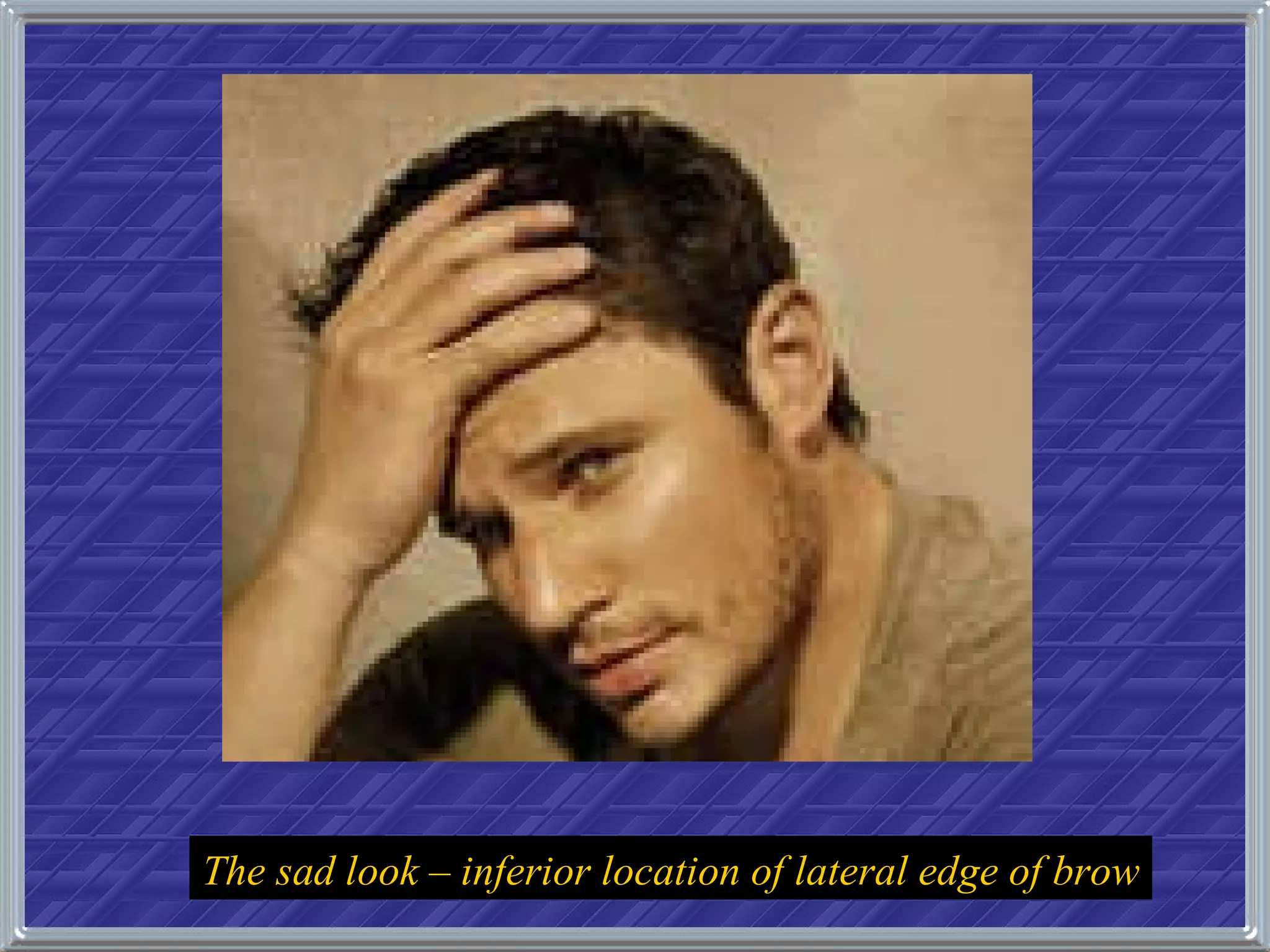 The sad look – inferior location of lateral edge of brow 