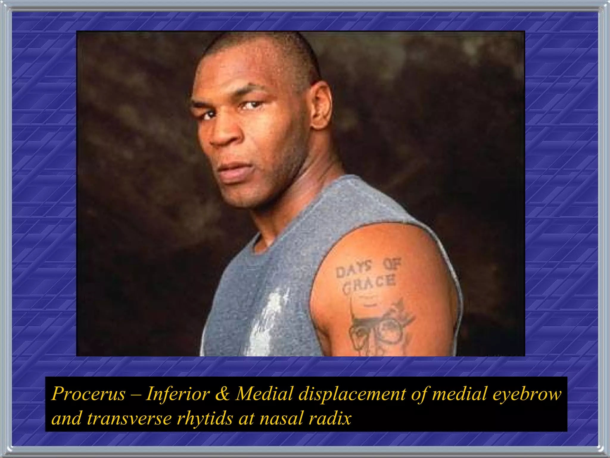 Procerus – Inferior & Medial displacement of medial eyebrow and transverse rhytids at nasal radix 