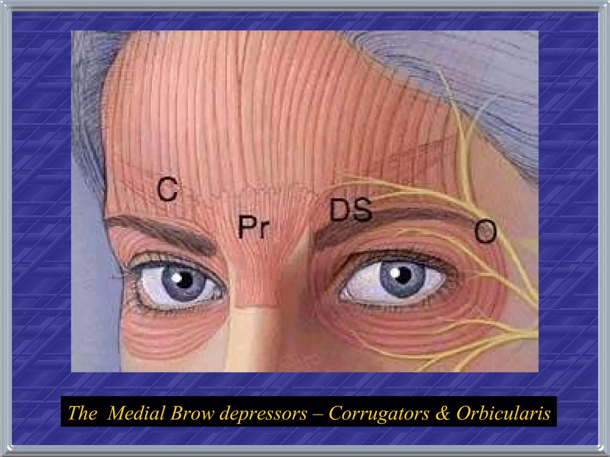 The  Medial Brow depressors – Corrugators & Orbicularis 