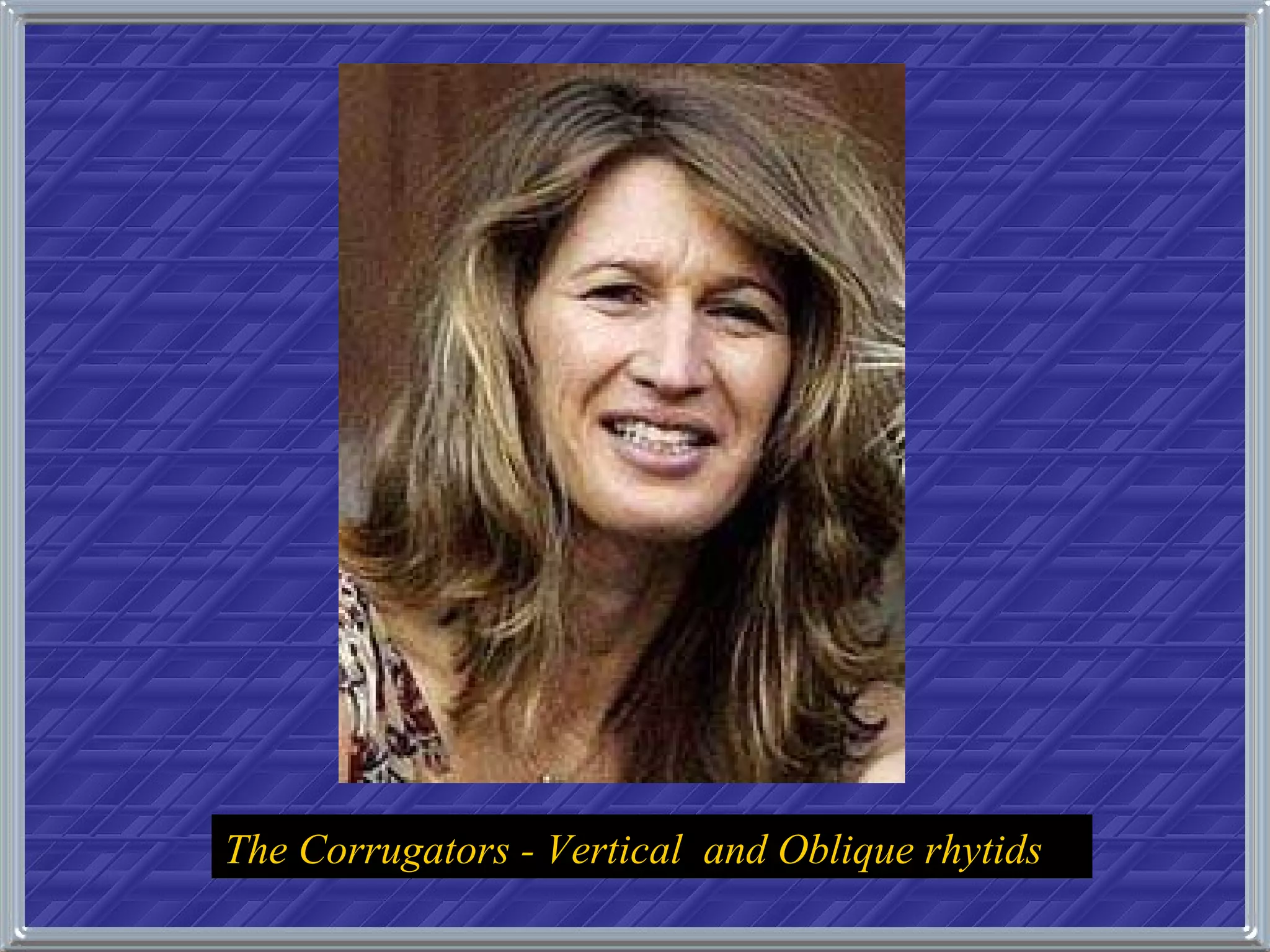 The Corrugators - Vertical  and Oblique rhytids   