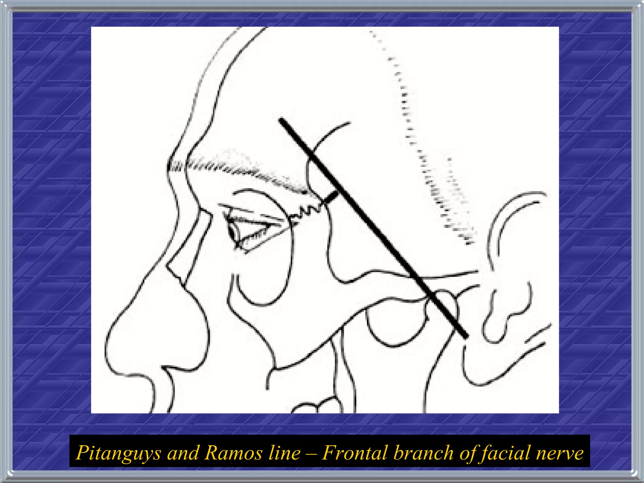 Pitanguys and Ramos line – Frontal branch of facial nerve 