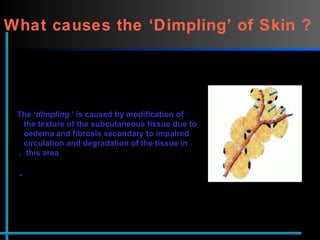 What causes the ‘Dimpling’ of Skin ?   The ‘ dimpling ’ is caused by modification of    the texture of the subcutaneous tissue due to    oedema and fibrosis secondary to impaired    circulation and degradation of the tissue in    this area.  
