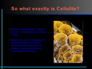 So what exactly is Cellulite?   Cellulite is localised fat ‘ caught    in a jail’  of interstitial connective    tissue  Cellulite is a lack of drainage of    fluid secondary to venous +    lymphatic stasis because of    genetic, hormonal and even    environmental reasons  