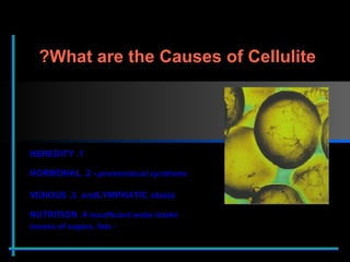 1. HEREDITY 2. HORMONAL  - premenstrual syndrome, 3. VENOUS  and  LYMPHATIC  stasis 4. NUTRITION   insufficient water intake - excess of sugars, fats What are the Causes of Cellulite?  