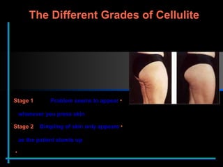 Stage 1   Problem seems to appear    whenever you press skin   Stage 2  Dimpling of skin only appears    as the patient stands up  The Different Grades of Cellulite 